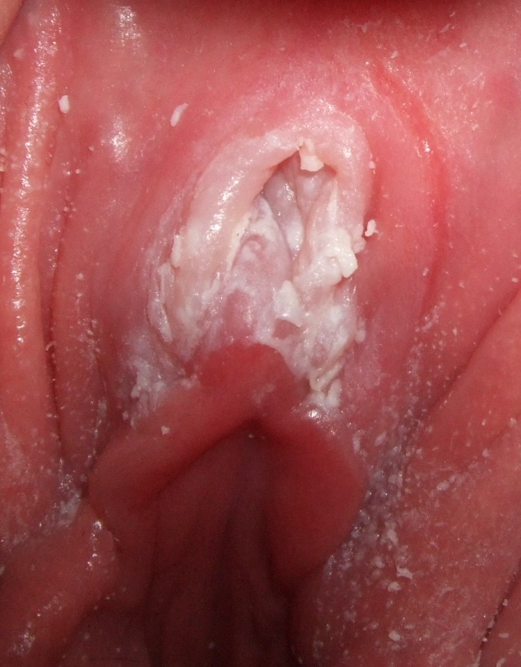 Candidosis vaginal: MedlinePlus enciclopedia médica