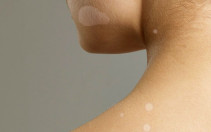 Remedios caseros para eliminar manchas blancas en la piel (hongos)