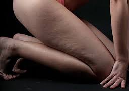 celulitis en las piernas