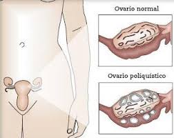 Trastornos del ciclo menstrual más comunes en muchas mujeres