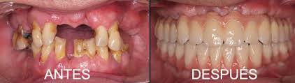 Mitos y verdades sobre los implantes dentales