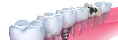 Implantes dentarios