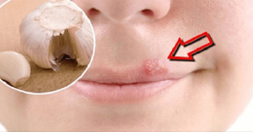 Remedios caseros para combatir el herpes labial