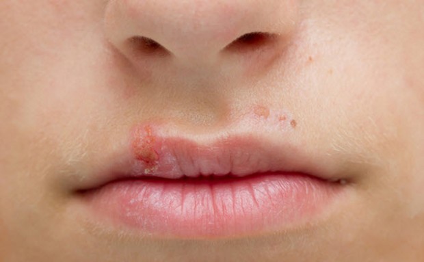 como curar el herpes labial