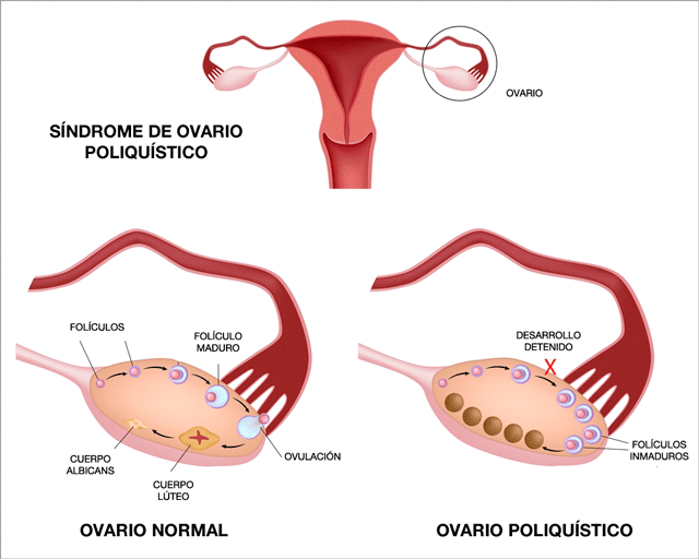 síndrome de ovario poliquístico