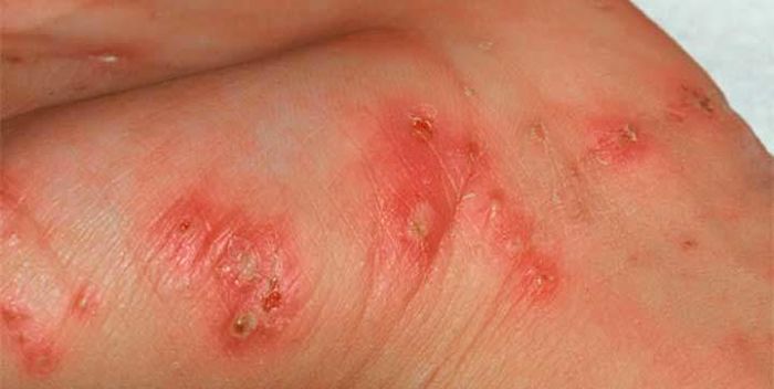 la escabiosis - enfermedades de la piel