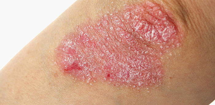 psoriasis - enfermedad de la piel