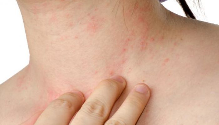 tipos de alergias en la piel