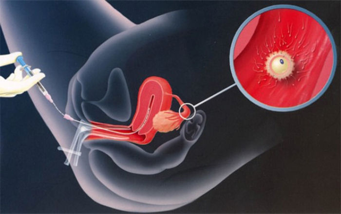  Riegos que puede ocasionar la inseminación artificial