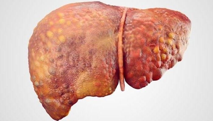remedios para el hígado graso