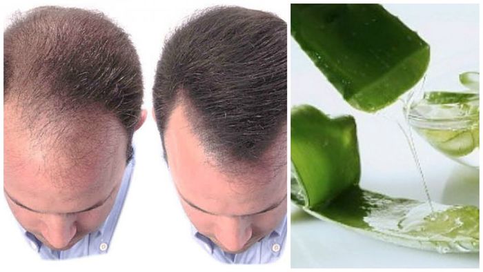 Tratamiento Para La Alopecia Areata naturales de aloe vera