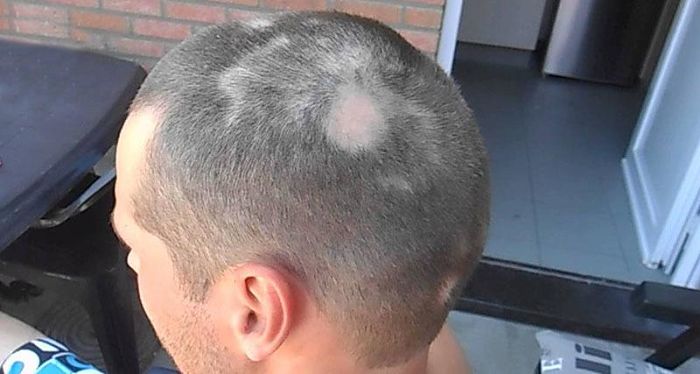 Tratamiento Para La Alopecia Areata
